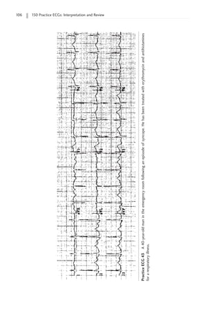 106 150 Practice ECGs: Interpretation and Review
Practice
ECG
43
A
40-year-old
man
in
the
emergency
room
following
an
episode
of
syncope.
He
has
been
treated
with
erythromycin
and
antihistamines
for
a
respiratory
illness.
 