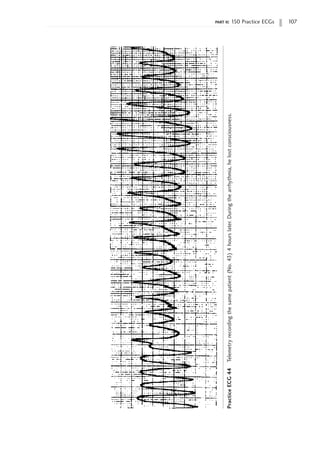 part ii: 150 Practice ECGs 107
Practice
ECG
44
Telemetry
recording
the
same
patient
(No.
43)
4
hours
later.
During
the
arrhythmia,
he
lost
consciousness.
 