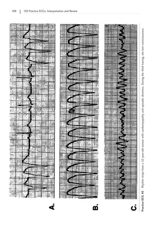 108 150 Practice ECGs: Interpretation and Review
Practice
ECG
45
Rhythm
strips
from
a
52-year-old
woman
with
cardiomyopathy
and
episodic
dizziness.
During
the
third
tracing,
she
lost
consciousness.
 
