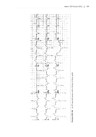 part ii: 150 Practice ECGs 109
Practice
ECG
46
An
87-year-old
woman
with
a
history
of
dizzy
spells.
 