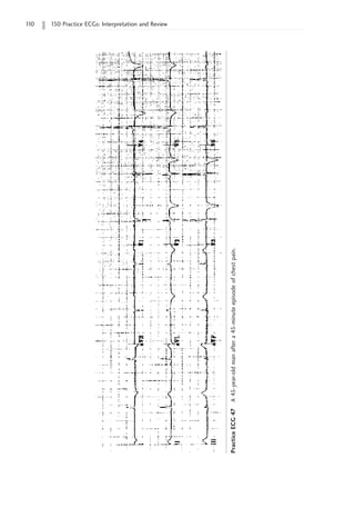 1
10 150 Practice ECGs: Interpretation and Review
Practice
ECG
47
A
45-year-old
man
after
a
45-minute
episode
of
chest
pain.
 
