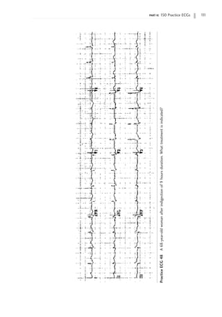 part ii: 150 Practice ECGs 1
1
1
Practice
ECG
48
A
68-year-old
woman
after
indigestion
of
9
hours
duration.
What
treatment
is
indicated?
 