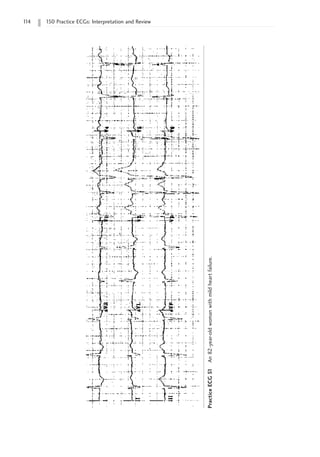 1
14 150 Practice ECGs: Interpretation and Review
Practice
ECG
51
An
82-year-old
woman
with
mild
heart
failure.
 