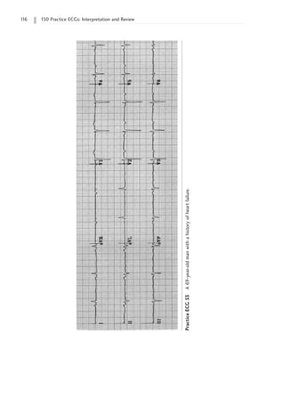 1
16 150 Practice ECGs: Interpretation and Review
Practice
ECG
53
A
69-year-old
man
with
a
history
of
heart
failure.
 