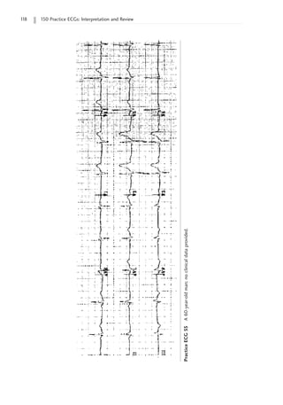 1
18 150 Practice ECGs: Interpretation and Review
Practice
ECG
55
A
60-year-old
man;
no
clinical
data
provided.
 