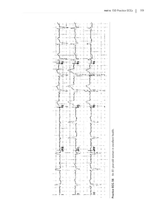 part ii: 150 Practice ECGs 1
19
Practice
ECG
56
An
81-year-old
woman
in
excellent
health.
 