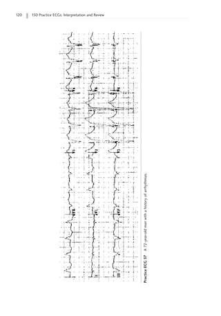 120 150 Practice ECGs: Interpretation and Review
Practice
ECG
57
A
72-year-old
man
with
a
history
of
arrhythmias.
 
