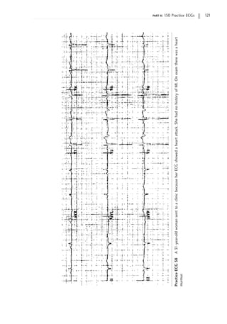 part ii: 150 Practice ECGs 121
Practice
ECG
58
A
31-year-old
woman
sent
to
a
clinic
because
her
ECG
showed
a
heart
attack.
She
had
no
history
of
MI.
On
exam
there
was
a
heart
murmur.
 
