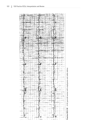 122 150 Practice ECGs: Interpretation and Review
Practice
ECG
59
A
64-year-old
woman
with
emphysema
and
ankle
edema.
 