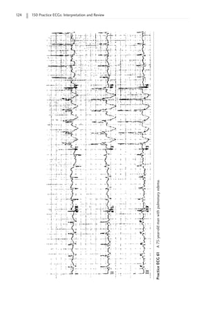 124 150 Practice ECGs: Interpretation and Review
Practice
ECG
61
A
75-year-old
man
with
pulmonary
edema.
 