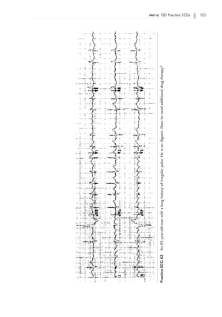 part ii: 150 Practice ECGs 125
Practice
ECG
62
An
83-year-old
man
with
a
long
history
of
irregular
pulse.
He
is
on
digoxin.
Does
he
need
additional
drug
therapy?
 