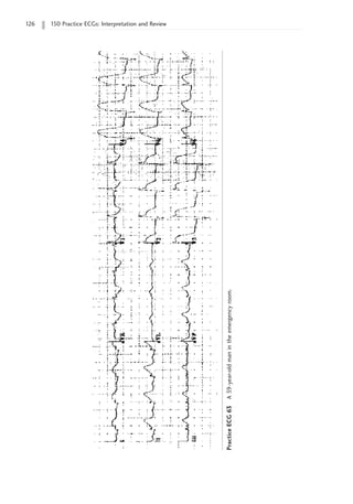 126 150 Practice ECGs: Interpretation and Review
Practice
ECG
63
A
59-year-old
man
in
the
emergency
room.
 