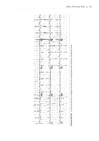 part ii: 150 Practice ECGs 127
Practice
ECG
64
An
82-year-old
man
on
digoxin
sent
from
the
nursing
home
with
confusion
and
blurred
vision.
 
