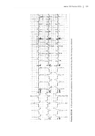 part ii: 150 Practice ECGs 129
Practice
ECG
66
A
26-year-old
woman
with
palpitations.
Her
ECG
was
normal
the
day
after
this
tracing
was
obtained.
 