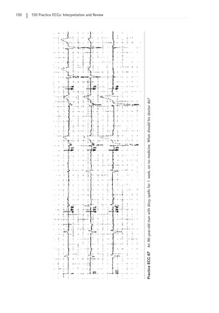130 150 Practice ECGs: Interpretation and Review
Practice
ECG
67
An
86-year-old
man
with
dizzy
spells
for
1
week,
on
no
medicine.
What
should
his
doctor
do?
 