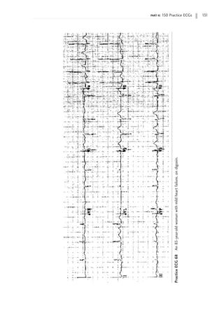 part ii: 150 Practice ECGs 131
Practice
ECG
68
An
85-year-old
woman
with
mild
heart
failure,
on
digoxin.
 