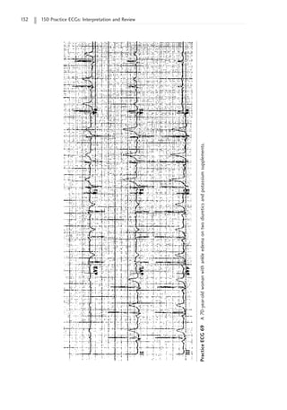 132 150 Practice ECGs: Interpretation and Review
Practice
ECG
69
A
70-year-old
woman
with
ankle
edema
on
two
diuretics
and
potassium
supplements.
 