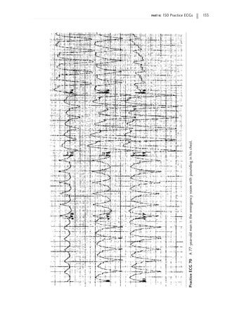 part ii: 150 Practice ECGs 133
Practice
ECG
70
A
77-year-old
man
in
the
emergency
room
with
pounding
in
his
chest.
 