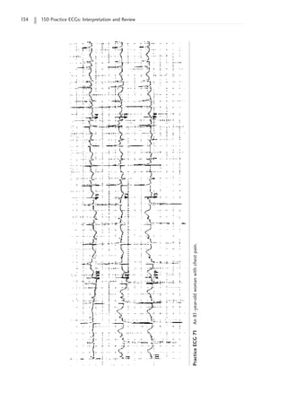 134 150 Practice ECGs: Interpretation and Review
Practice
ECG
71
An
81-year-old
woman
with
chest
pain.
 