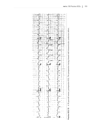 part ii: 150 Practice ECGs 135
Practice
ECG
72
A
78-year-old
woman,
postoperative
ECG.
The
preoperative
tracing
showed
mild
intraventricular
conduction
defect.
 