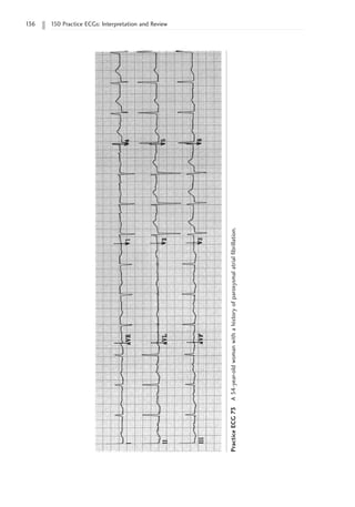 136 150 Practice ECGs: Interpretation and Review
Practice
ECG
73
A
54-year-old
woman
with
a
history
of
paroxysmal
atrial
fibrillation.
 