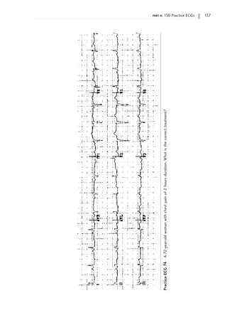 part ii: 150 Practice ECGs 137
Practice
ECG
74
A
72-year-old
woman
with
chest
pain
of
2
hours
duration.
What
is
the
correct
treatment?
 