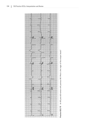 138 150 Practice ECGs: Interpretation and Review
Practice
ECG
75
An
80-year-old
woman
with
previous
MI.
What
is
the
origin
of
the
ectopic
beats?
 