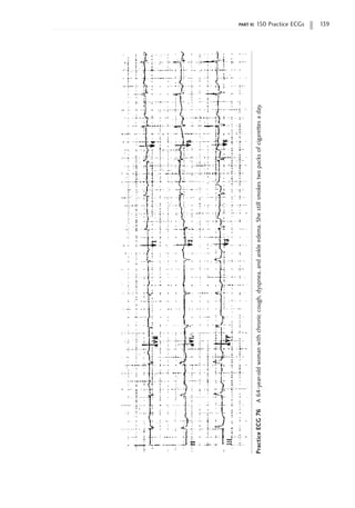 part ii: 150 Practice ECGs 139
Practice
ECG
76
A
64-year-old
woman
with
chronic
cough,
dyspnea,
and
ankle
edema.
She
still
smokes
two
packs
of
cigarettes
a
day.
 