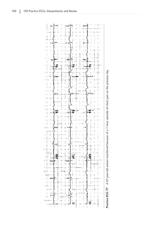140 150 Practice ECGs: Interpretation and Review
Practice
ECG
77
A
67-year-old
woman
transferred
because
of
a
1-hour
episode
of
chest
pain
on
the
previous
day.
 