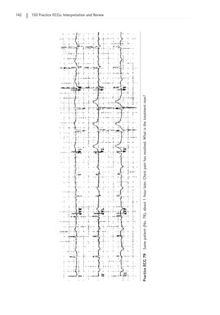 142 150 Practice ECGs: Interpretation and Review
Practice
ECG
79
Same
patient
(No.
78),
about
1
hour
later.
Chest
pain
has
resolved.
What
is
the
treatment
now?
 