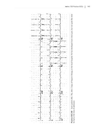 part ii: 150 Practice ECGs 143
Practice
ECG
80
Same
patient
(No.
78),
after
2
days
of
heparin
therapy
at
the
local
hospital.
He
has
developed
more
chest
pain,
but
not
quite
like
what
he
had
at
the
time
of
admission.
 