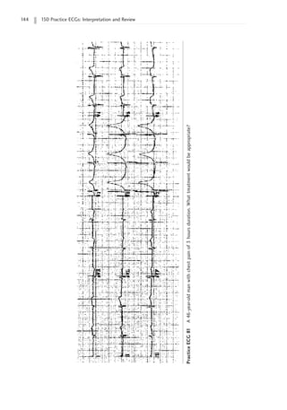 144 150 Practice ECGs: Interpretation and Review
Practice
ECG
81
A
46-year-old
man
with
chest
pain
of
3
hours
duration.
What
treatment
would
be
appropriate?
 