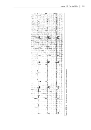 part ii: 150 Practice ECGs 145
Practice
ECG
82
A
60-year-old
woman
in
good
health;
routine
exam.
 