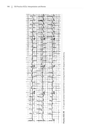 146 150 Practice ECGs: Interpretation and Review
Practice
ECG
83
A
75-year-old
woman
transferred
from
a
nursing
home
with
dyspnea
and
pleurisy.
 