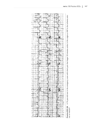 part ii: 150 Practice ECGs 147
Practice
ECG
84
A
74-year-old
man
in
the
emergency
room
with
chest
pain
that
began
30
minutes
earlier.
Is
this
angina
or
MI?
Is
the
ischemia
ante-
rior
or
interior?
 