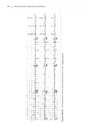 148 150 Practice ECGs: Interpretation and Review
Practice
ECG
85
A
56-year-old
man
with
no
cardiac
history;
he
wants
to
start
a
jogging
program.
 