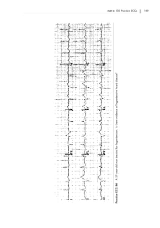 part ii: 150 Practice ECGs 149
Practice
ECG
86
A
57-year-old
man
treated
for
hypertension.
Is
there
evidence
of
hypertensive
heart
disease?
 