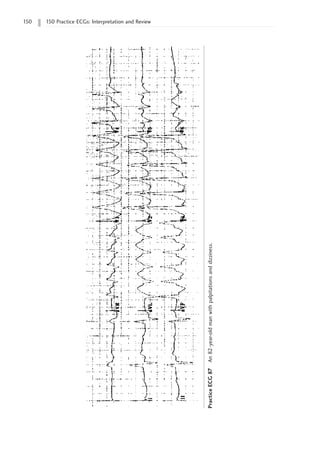 150 150 Practice ECGs: Interpretation and Review
Practice
ECG
87
An
82-year-old
man
with
palpitations
and
dizziness.
 