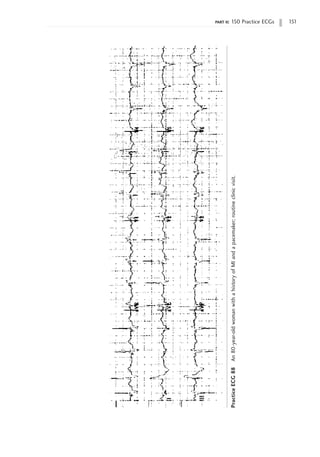 part ii: 150 Practice ECGs 151
Practice
ECG
88
An
80-year-old
woman
with
a
history
of
MI
and
a
pacemaker;
routine
clinic
visit.
 