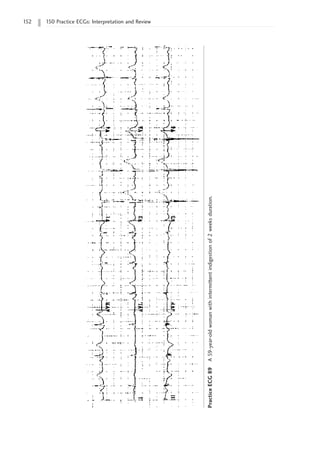 152 150 Practice ECGs: Interpretation and Review
Practice
ECG
89
A
59-year-old
woman
with
intermittent
indigestion
of
2
weeks
duration.
 