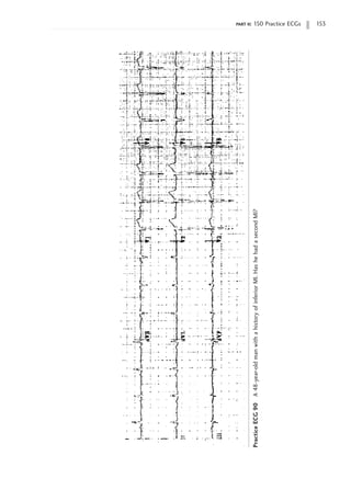 part ii: 150 Practice ECGs 153
Practice
ECG
90
A
48-year-old
man
with
a
history
of
inferior
MI.
Has
he
had
a
second
MI?
 