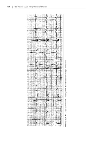 154 150 Practice ECGs: Interpretation and Review
Practice
ECG
91
A
50-year-old
with
a
history
of
MI.
Have
there
been
multiple
infarctions?
 