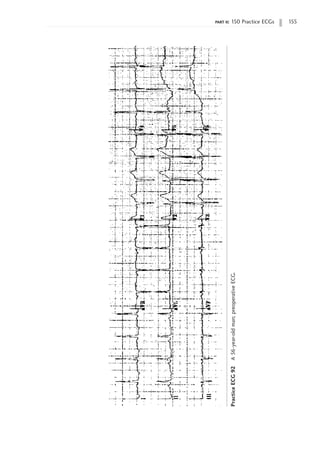 part ii: 150 Practice ECGs 155
Practice
ECG
92
A
56-year-old
man;
preoperative
ECG.
 