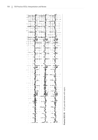 156 150 Practice ECGs: Interpretation and Review
Practice
ECG
93
A
65-year-old
woman
with
sepsis.
 