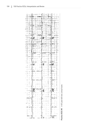 158 150 Practice ECGs: Interpretation and Review
Practice
ECG
95
A
63-year-old
man;
annual
exam.
 