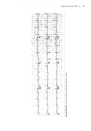 part ii: 150 Practice ECGs 159
Practice
ECG
96
A
71-year-old
man
with
chest
pain
for
3
hours.
 