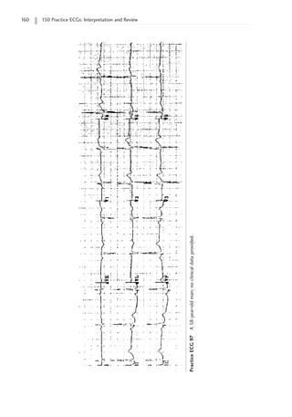 160 150 Practice ECGs: Interpretation and Review
Practice
ECG
97
A
58-year-old
man;
no
clinical
data
provided.
 