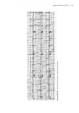 part ii: 150 Practice ECGs 161
Practice
ECG
98
An
81-year-old
woman;
no
clinical
data
provided.
 