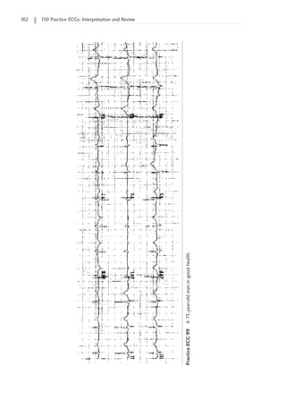 162 150 Practice ECGs: Interpretation and Review
Practice
ECG
99
A
73-year-old
man
in
good
health.
 