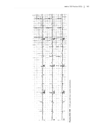 part ii: 150 Practice ECGs 163
Practice
ECG
100
A
63-year-old
man;
routine
examination.
 